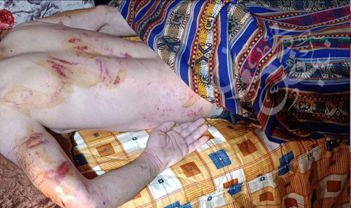 Picture of the body of a palestinian after he was tortured by Jewish KKK settlers and IoF soldiers 